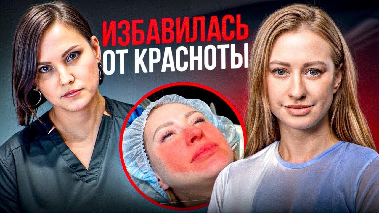 Лучший способ избавиться от красноты лица. Лечим розацеа лазером
