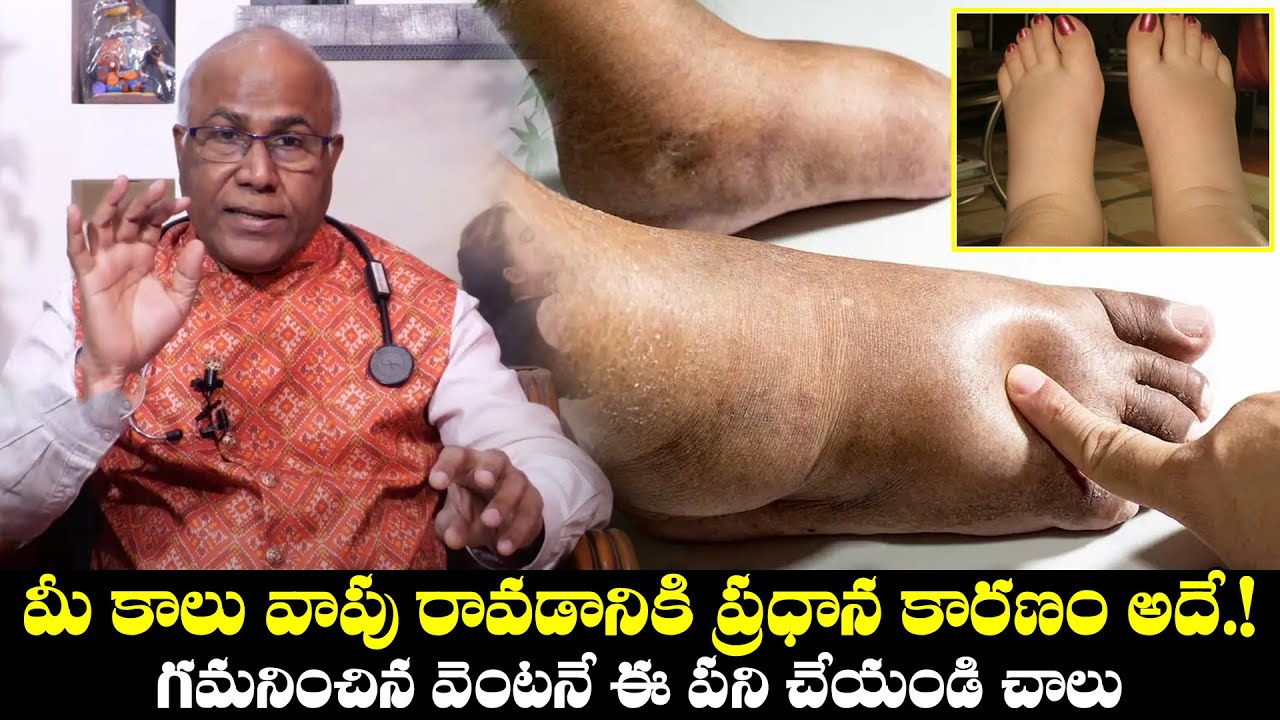 పాదాల వాపు ఎందుకు వస్తుంది? | C L Venkat Rao About Legs Swelling, Causes and Treatments in Telugu