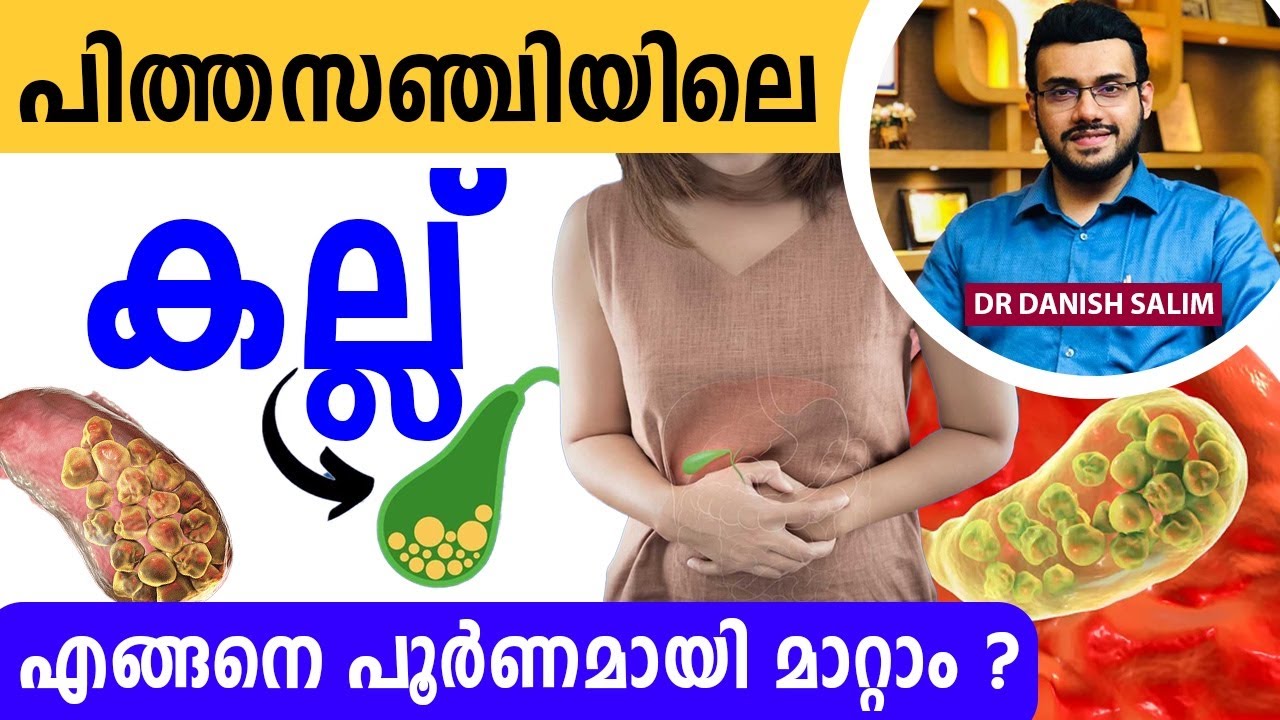 പിത്തസഞ്ചിയിൽ കല്ലുള്ളവർക്ക് എന്ത് ചികിത്സയാണ് എടുക്കേണ്ടത് ? Treatment of Gall bladder stone