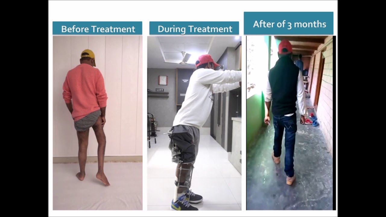 Polio treatment -Post Polio Syndrome- Hand Thigh gait ,Treated with Ilizarov , Computerized Hexapod