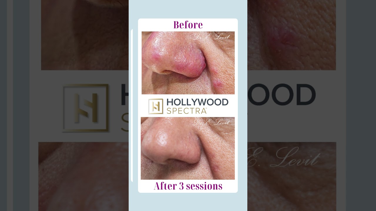 Hollywood Spectra Laser—the go-to treatment for achieving that red carpet glow!