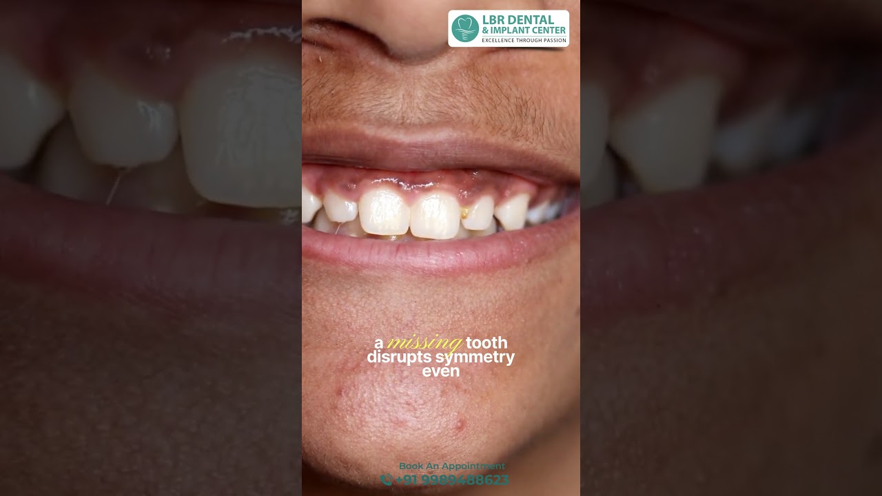 Tired of Feeling Insecure About Your Smile? Try Dental Implants Today! | LBR Dental