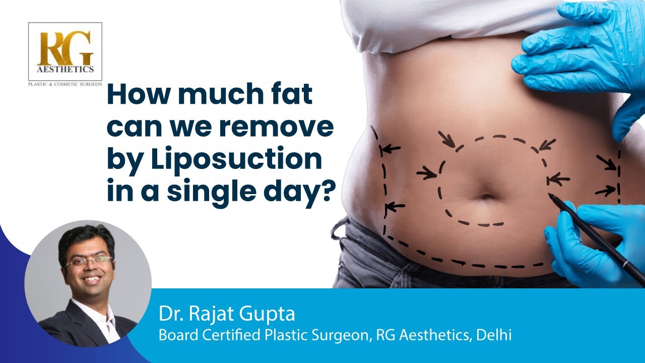 How much fat can we remove by Liposuction in a single day? | Dr Rajat Gupta Cosmetic Plastic Surgeon