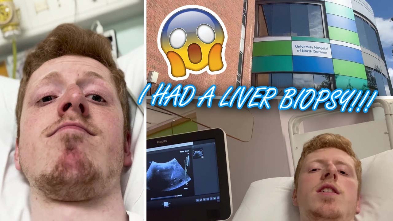 I HAD A LIVER BIOPSY!! (vlog + health update!)