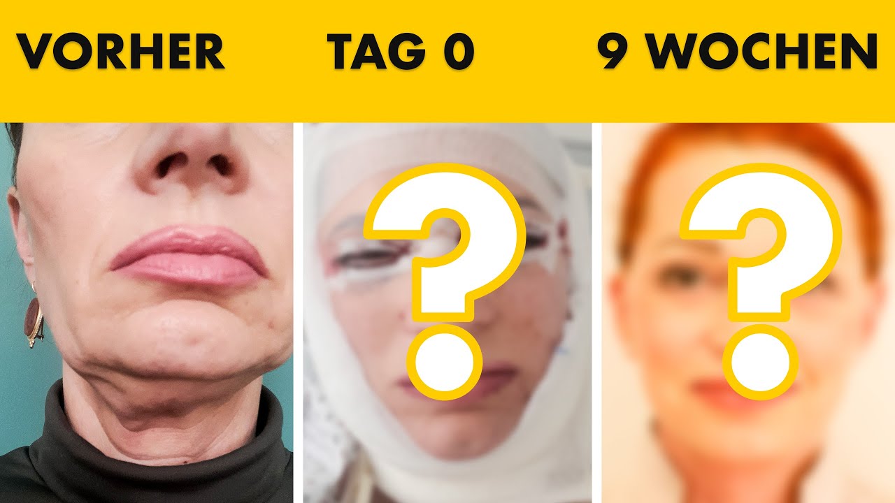 Heilungsprozess von Tag 0 bis 9 Wochen nach Facelift-OP!