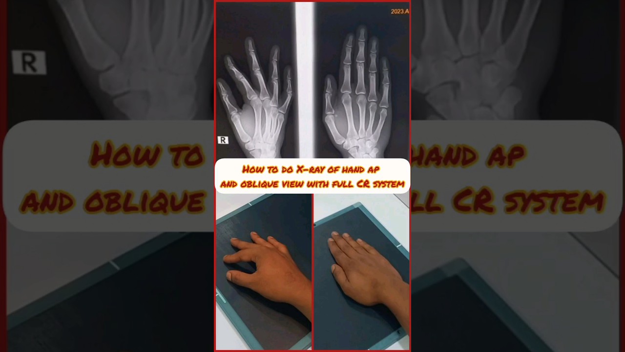 How to do X-ray of hand ap and oblique view with full CR system #shorts #anatomy