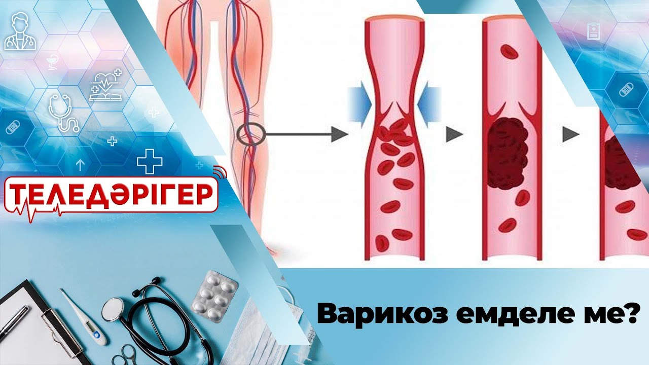 Варикоз емделе ме? І «Теледәрігер»