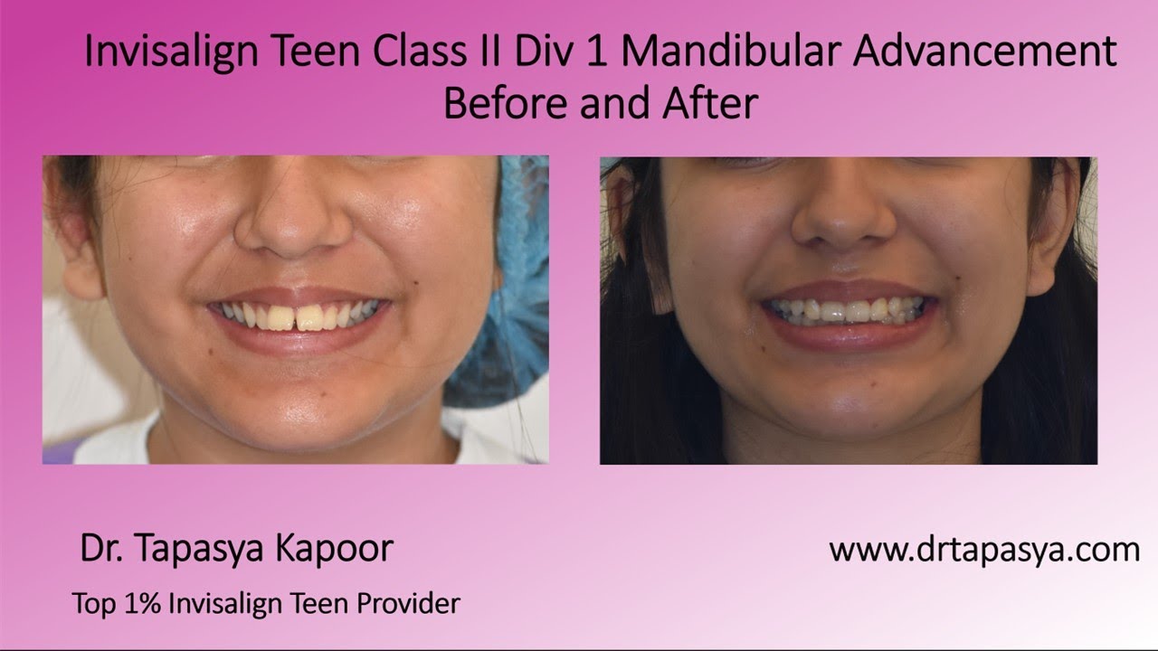 Invisalign Teen Treatment: Class II Correction with Mandibular Advancement