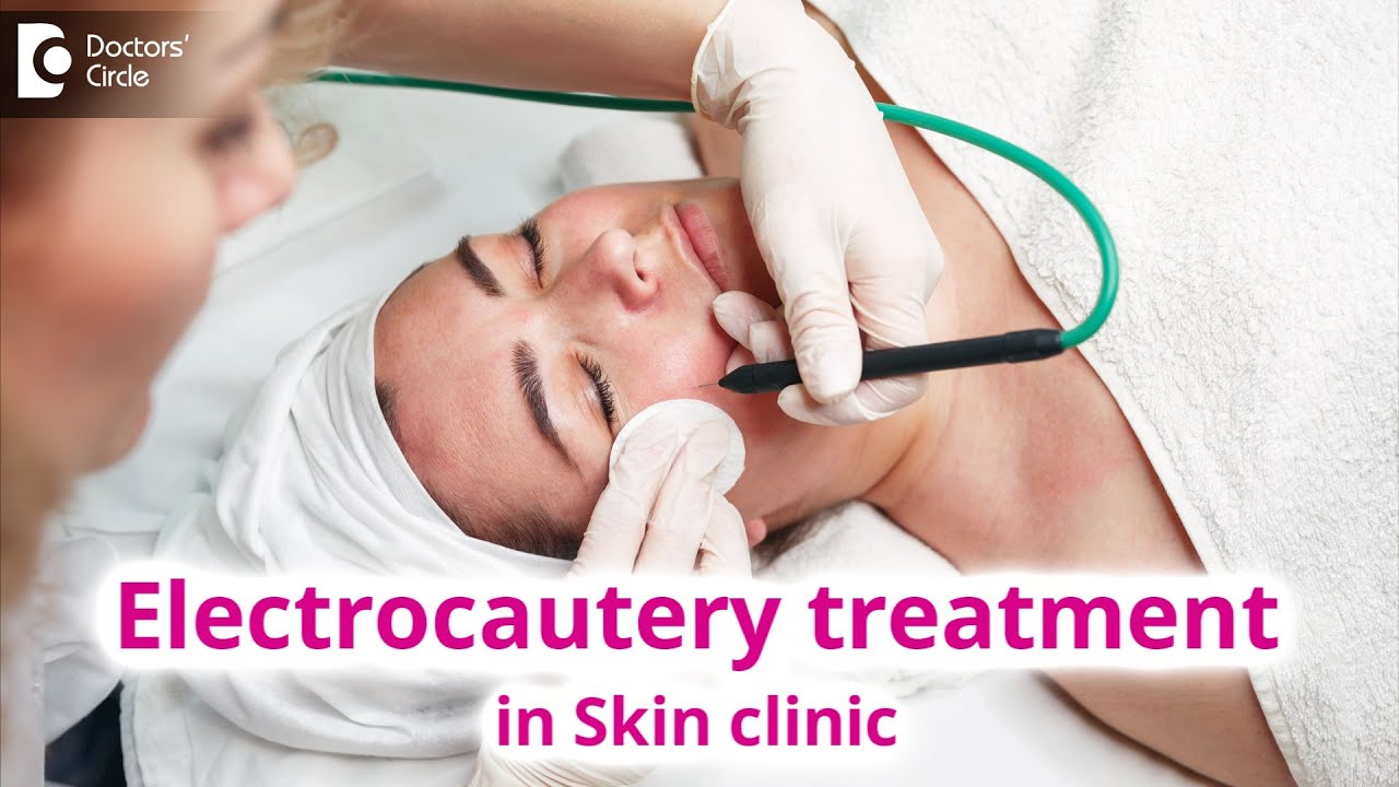 Use of Electrocautery Treatment in Skin Clinic | Electrocautery -  Dr. Rasya Dixit | Doctors' Circle