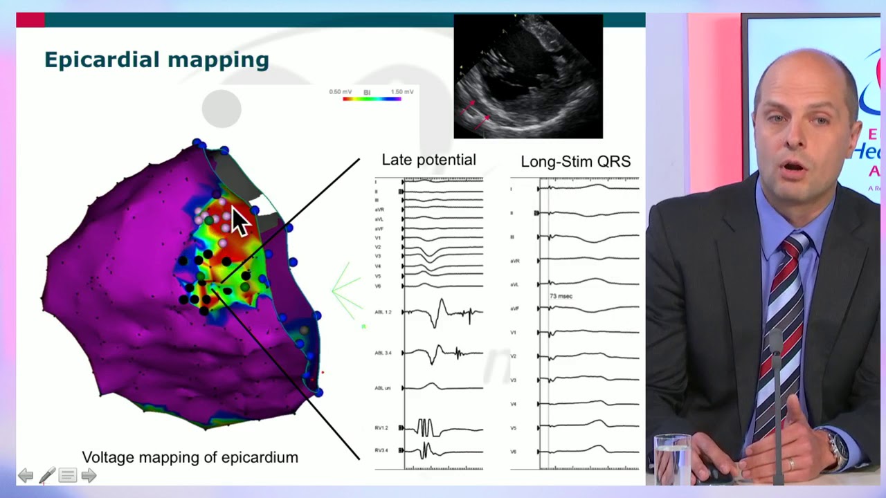 EHRA free webinar: New mapping tools for VT ablation
