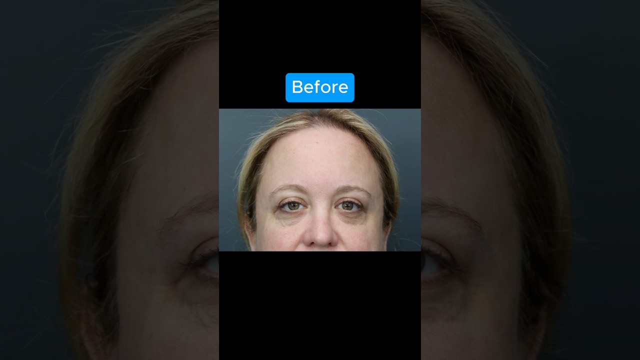 INCREDIBLE Transformation #blepharoplasty