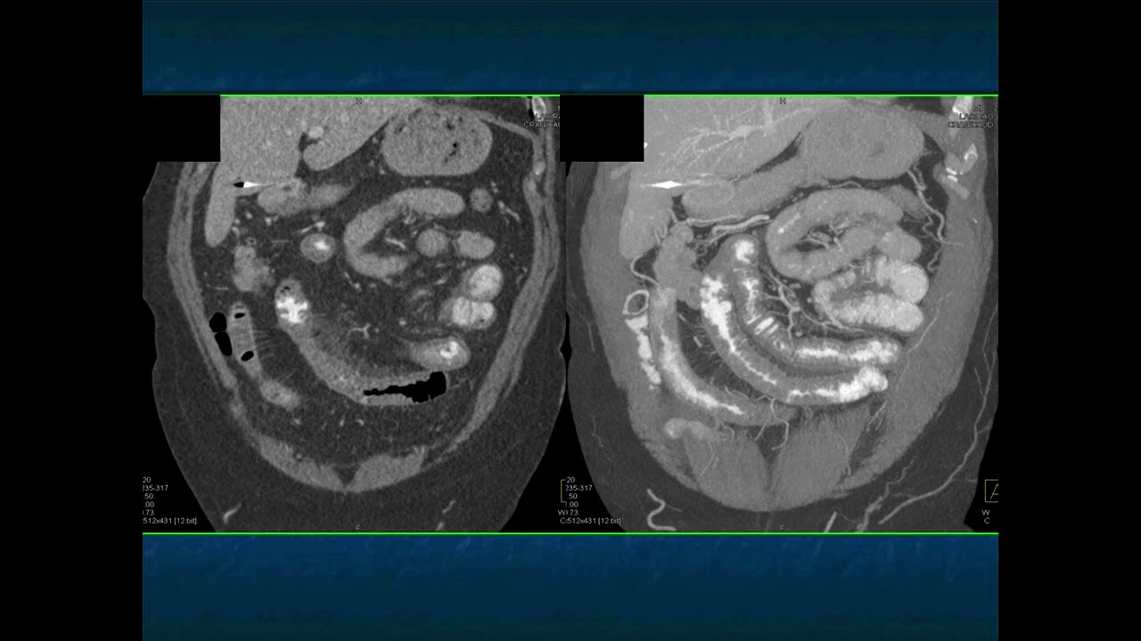 Abdominal Pain in the ER: GI Pathology - Part 1