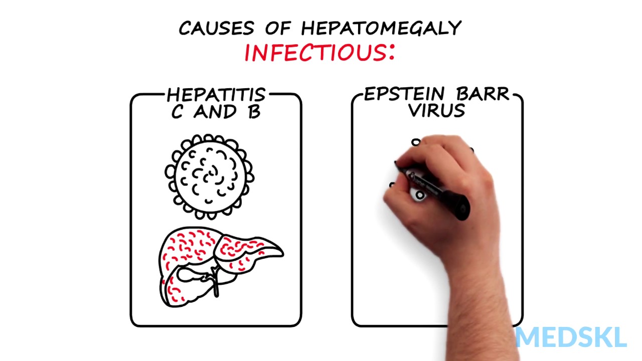 Gastroenterology &ndash; Hepatomegaly: By Kelly Burak M.D.