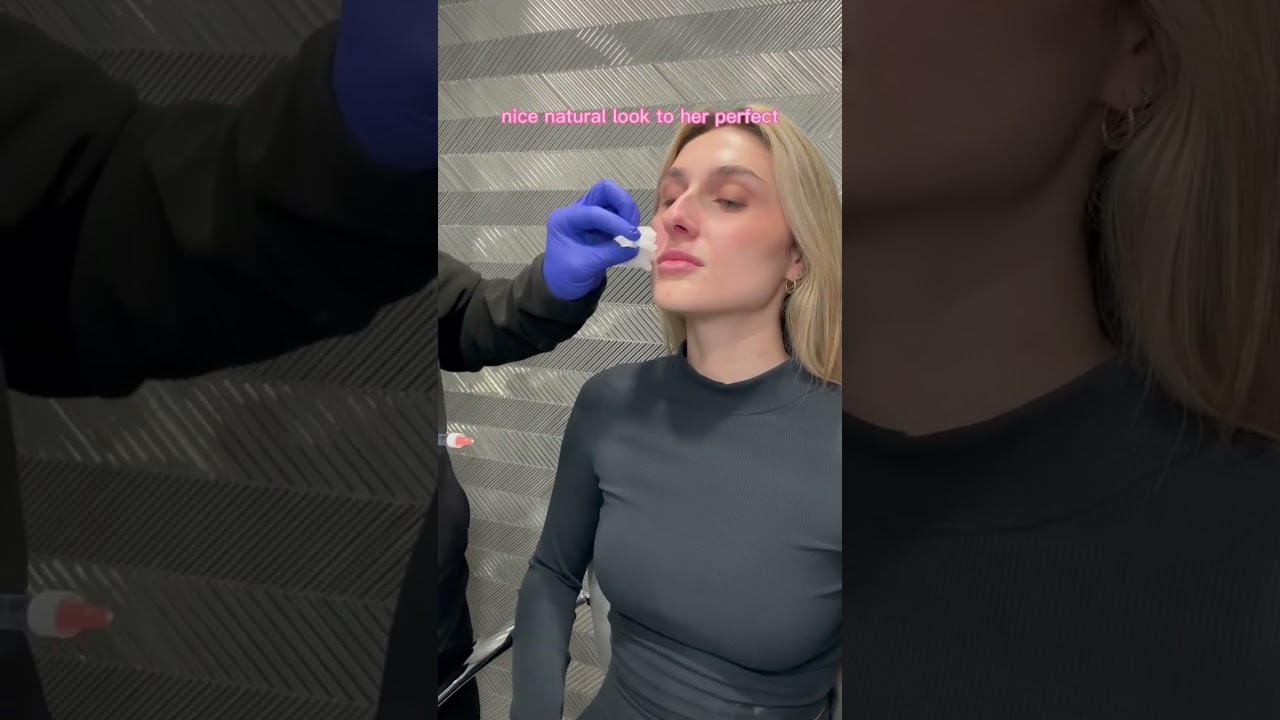 Restylane kysse lip injections  Perfect before Valentine&rsquo;s Day#plasticsurgeon #lipfiller #injector