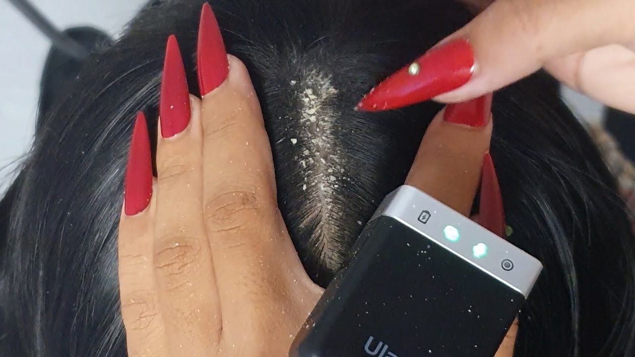 Dry Flake Removal Therapy ASMR 💆‍♀️✨ | Itchy Spots, Peeling & Deep Sleep Triggers #VF0079