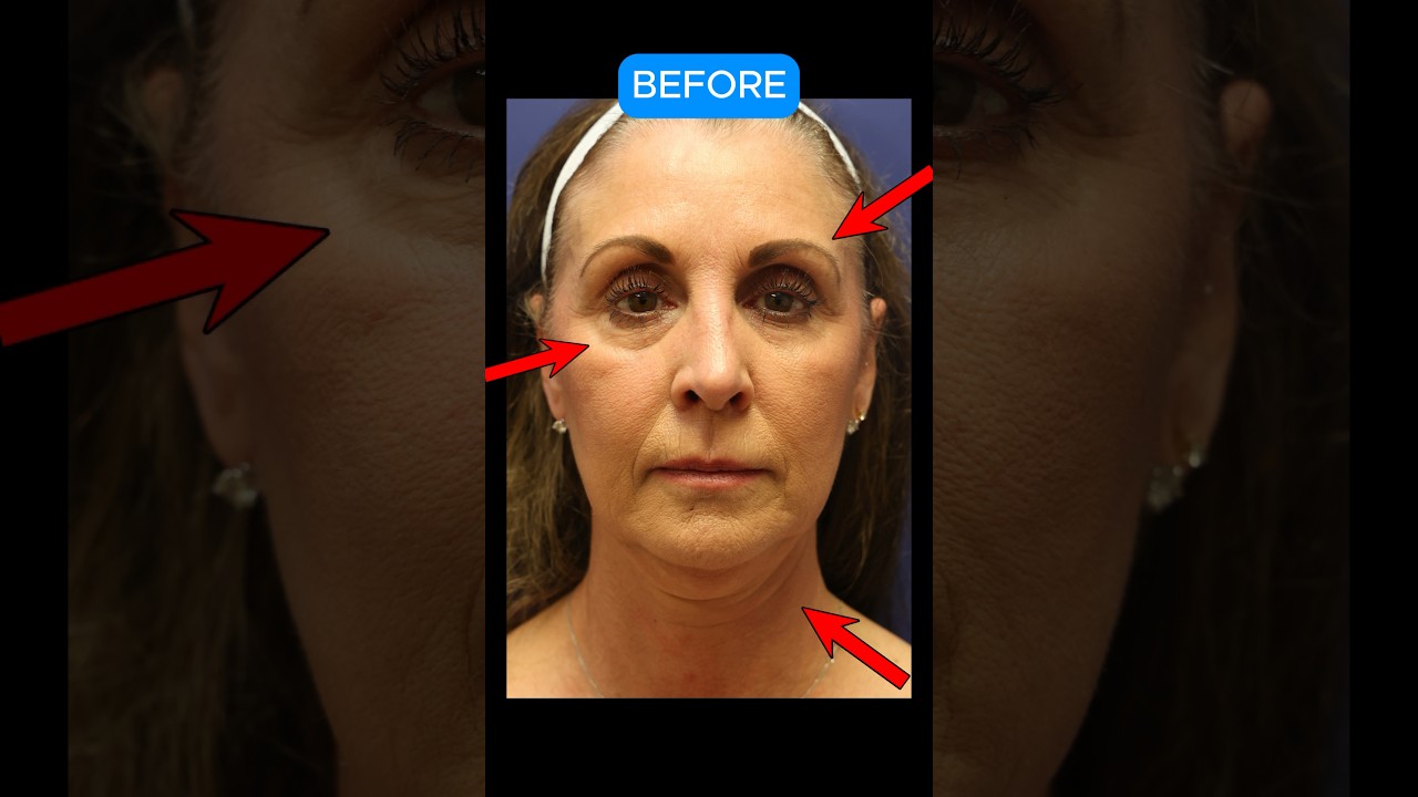STUNNING Facelift Transformation! #facelift