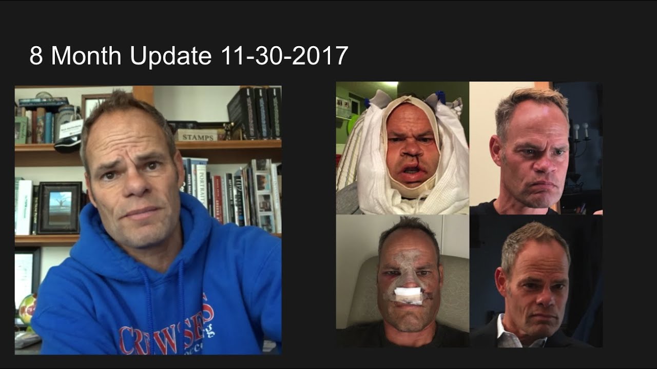 Double Jaw Surgery - Sleep Apnea - 8 Months
