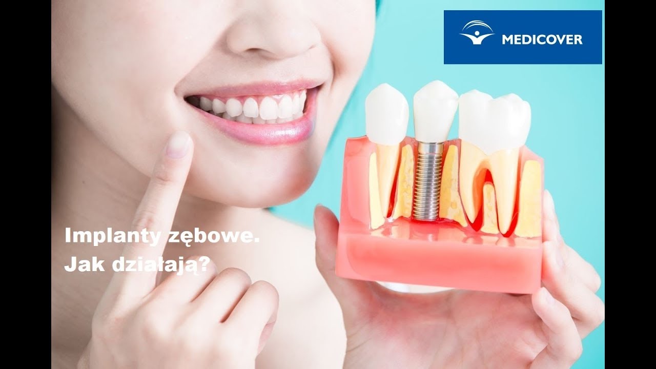 Implanty zębowe. Jak działają?