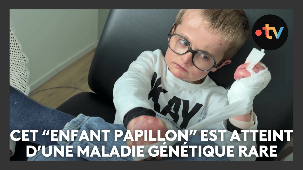 Cet enfant de 6 ans est atteint d'une maladie g&eacute;n&eacute;tique rare, l'&eacute;pidermolyse bulleuse