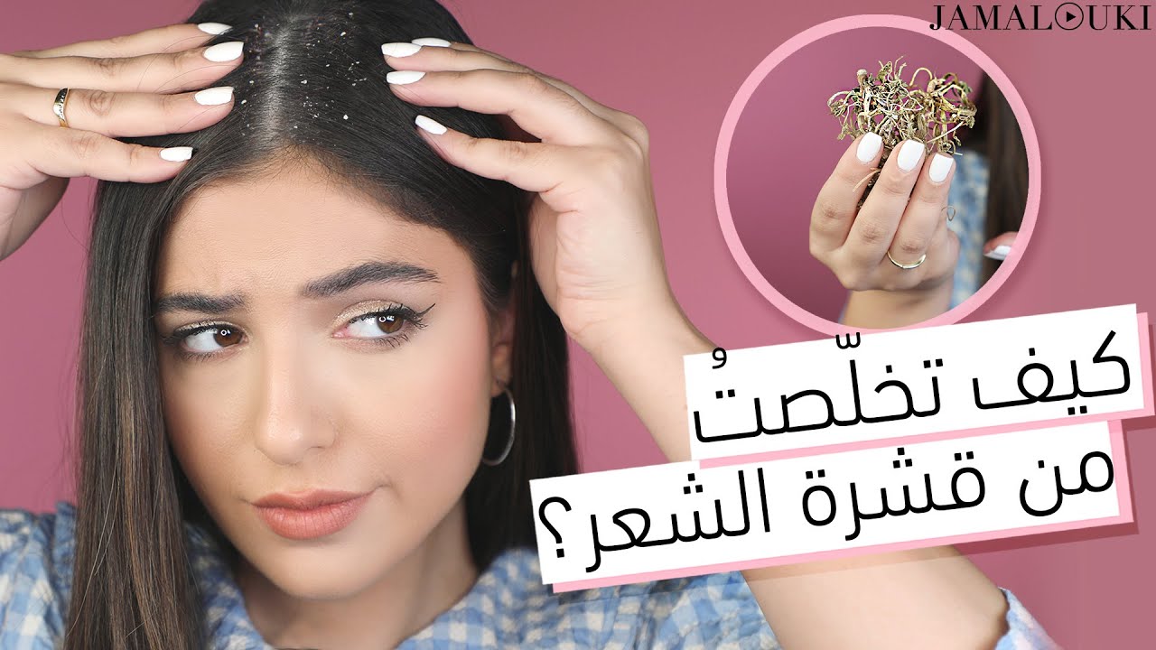 علاج قشرة الشعر من الاستعمال الأول | خلطة جدتي