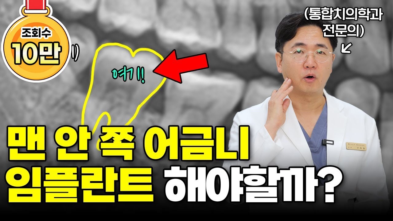 맨 안쪽 어금니 임플란트 해야 한다고 들으셨다면 이 영상을 꼭 보셔야 합니다