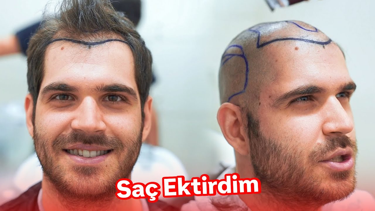 SAÇ EKTİRDİM...