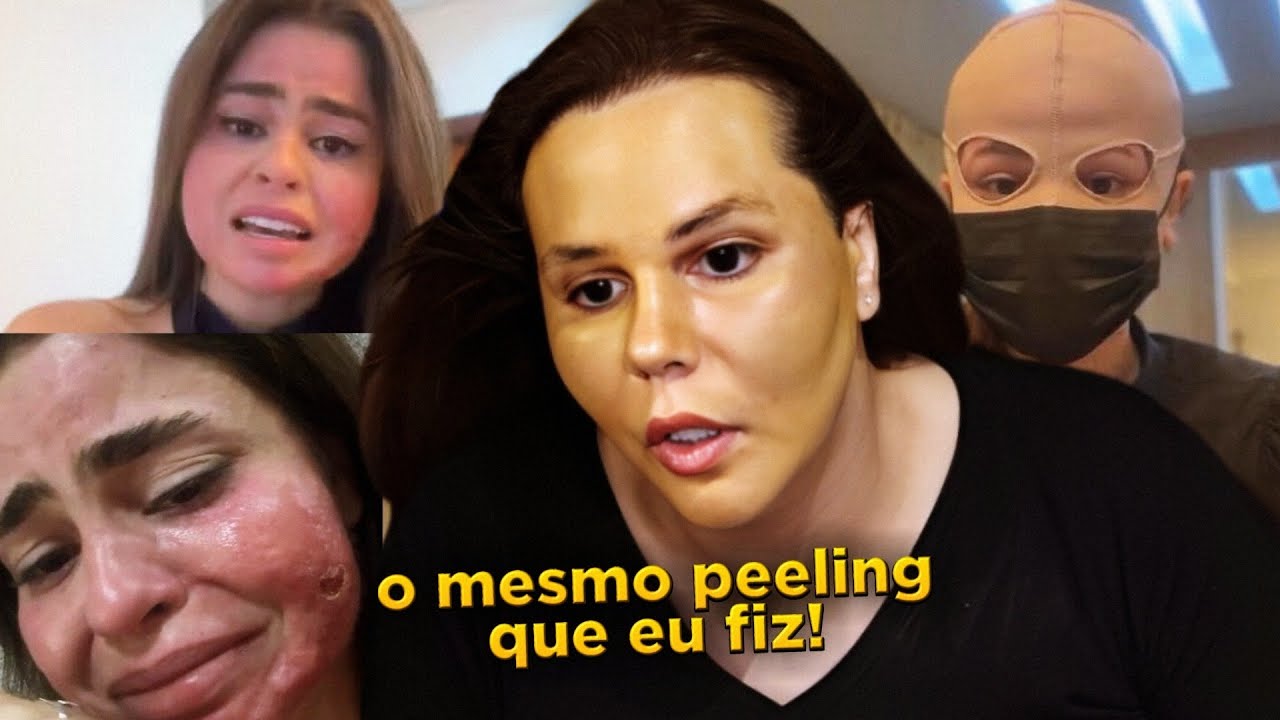 Mulher faz PEELING DE ATA (o mesmo que fiz) DE FORMA INCORRETA e SOFRE QUEIMADURAS SEVERAS