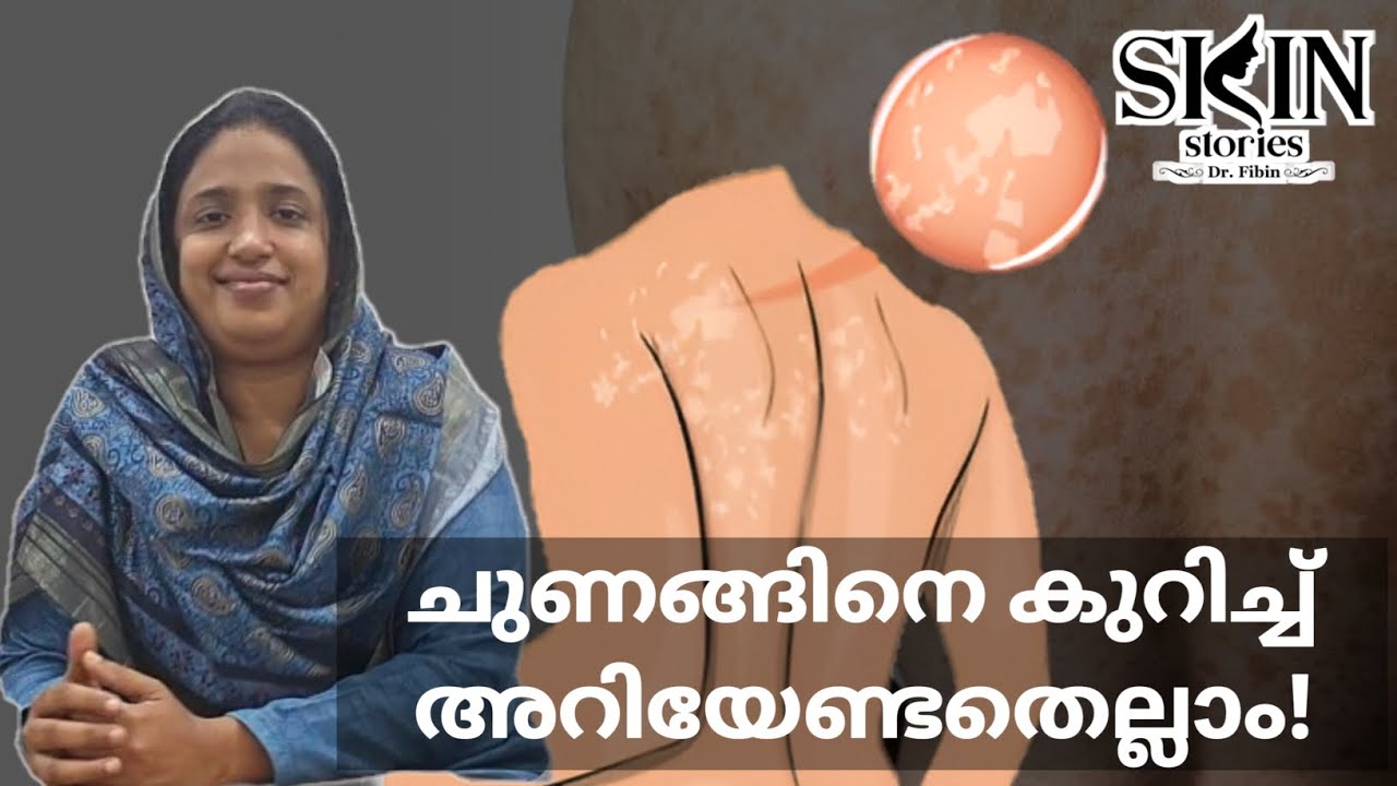 ചുണങ്ങിനെ കുറിച്ച് അറിയേണ്ടതെല്ലാം!