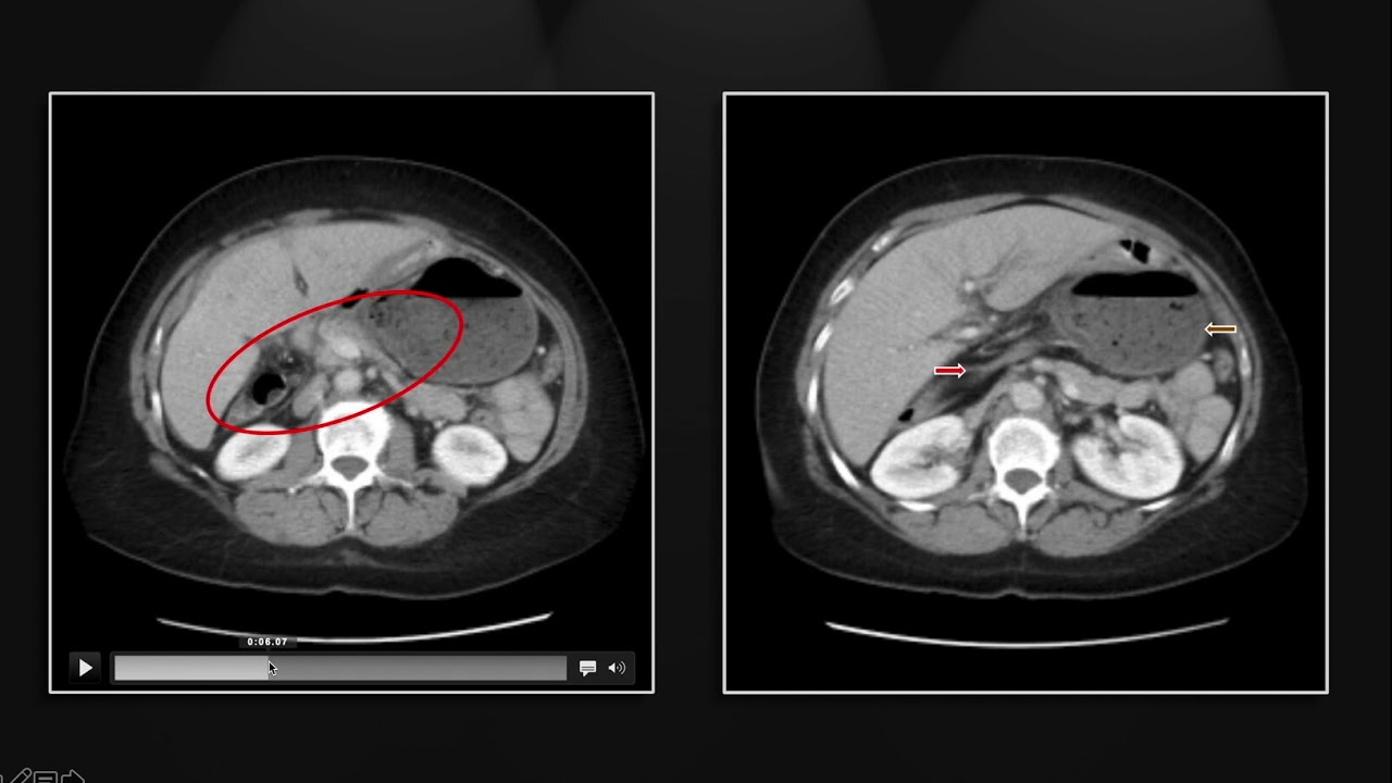 Colonic Emergencies | Interesting Radiology Cases