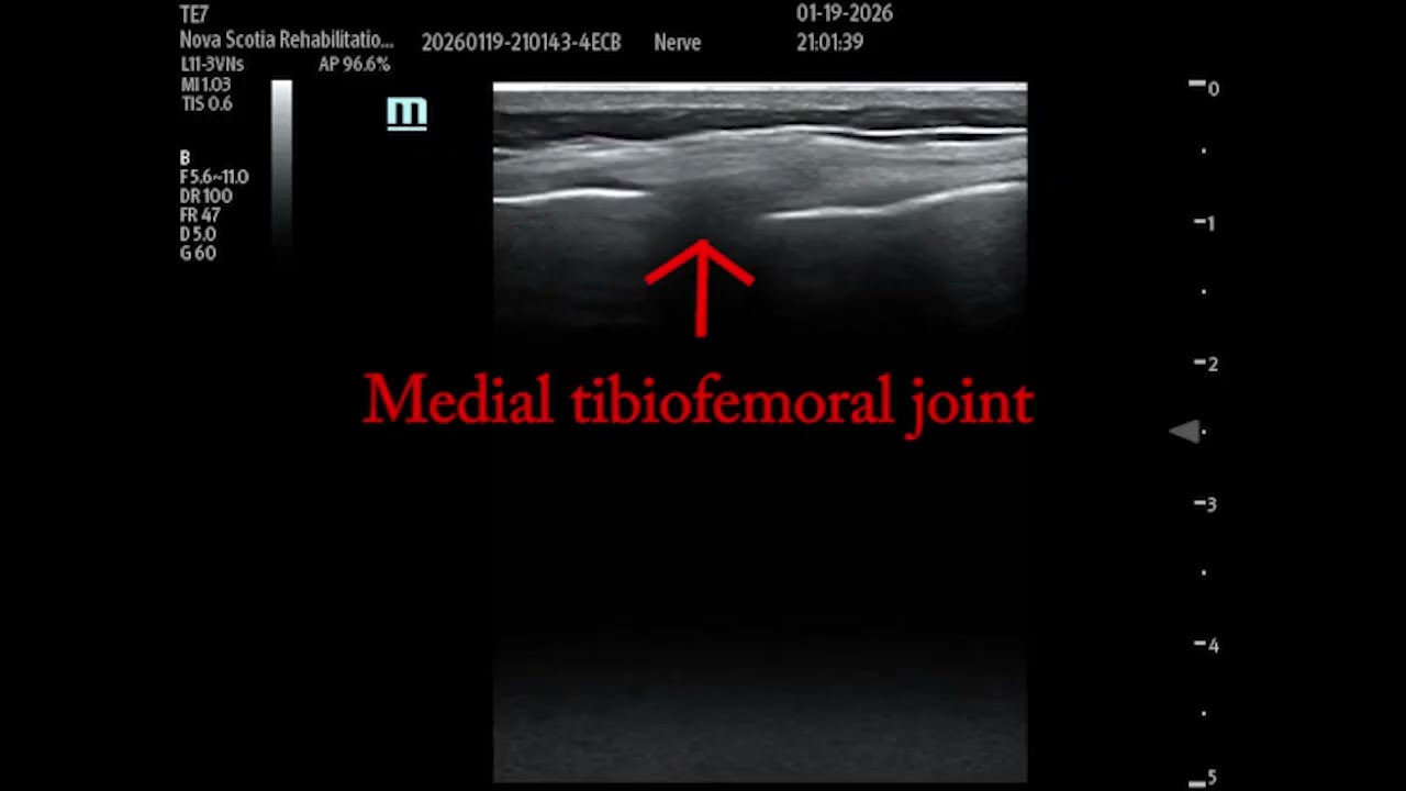 Ultrasound guided genicular nerve blocks