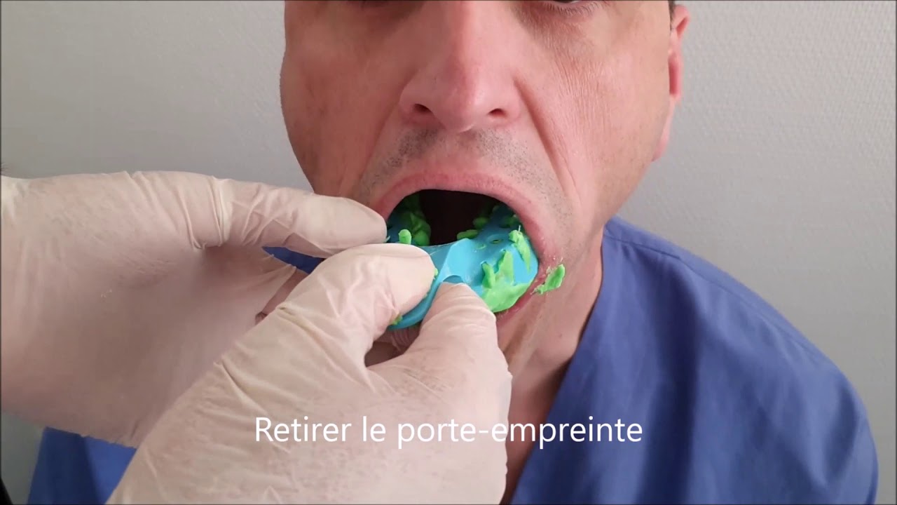 Prise d'empreinte dentaire alginate