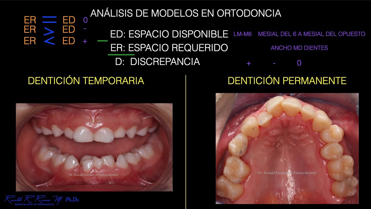 ANÁLISIS DE MODELOS EN DENTICIÓN TEMPORARIA Y PERMANENTE
