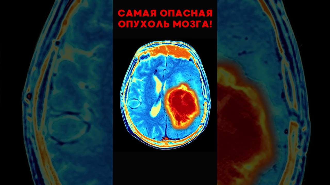 Почему ГЛИОБЛАСТОМА - САМАЯ ОПАСНАЯ опухоль головного мозга? #меднавигатор #опухоль #онкология #рак