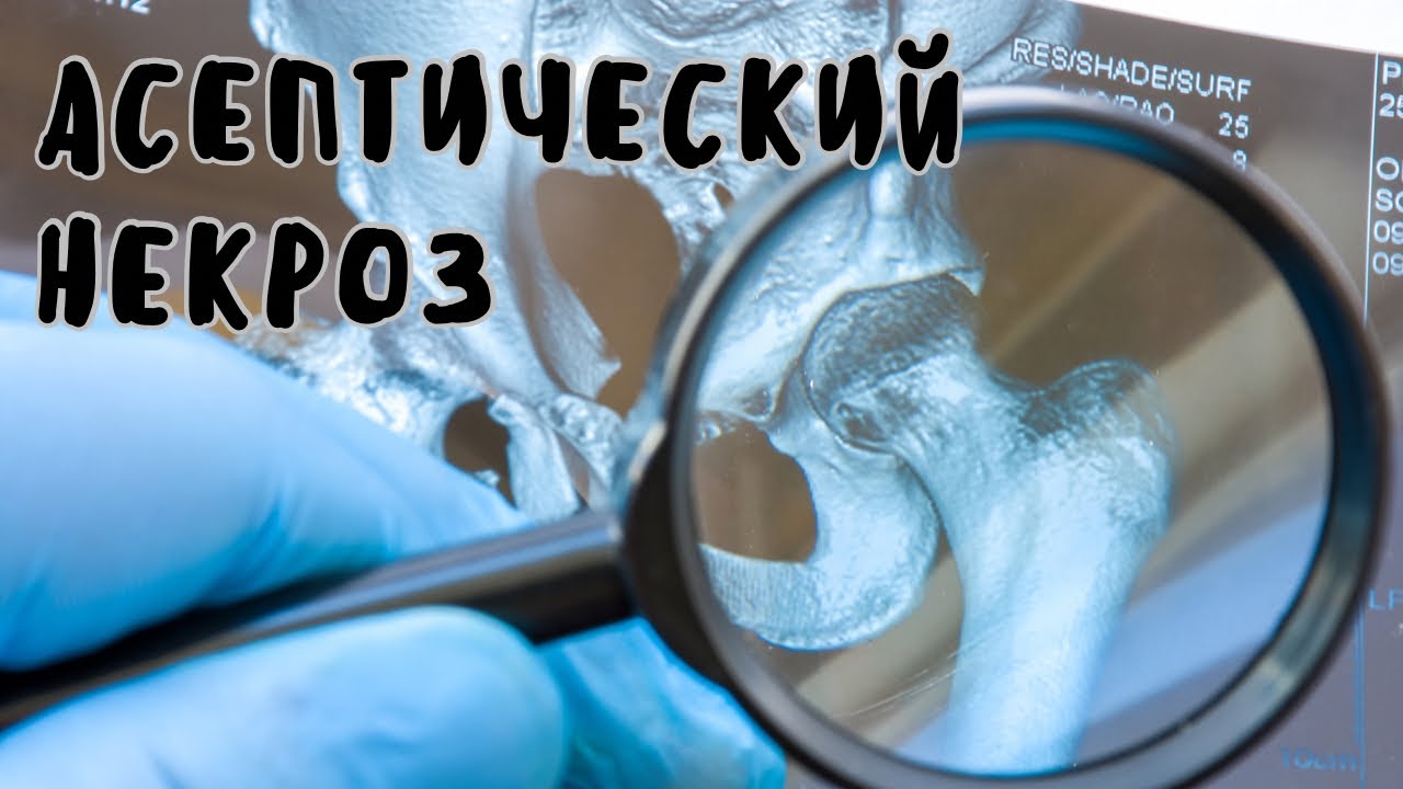 Асептический некроз | лечение и реабилитация