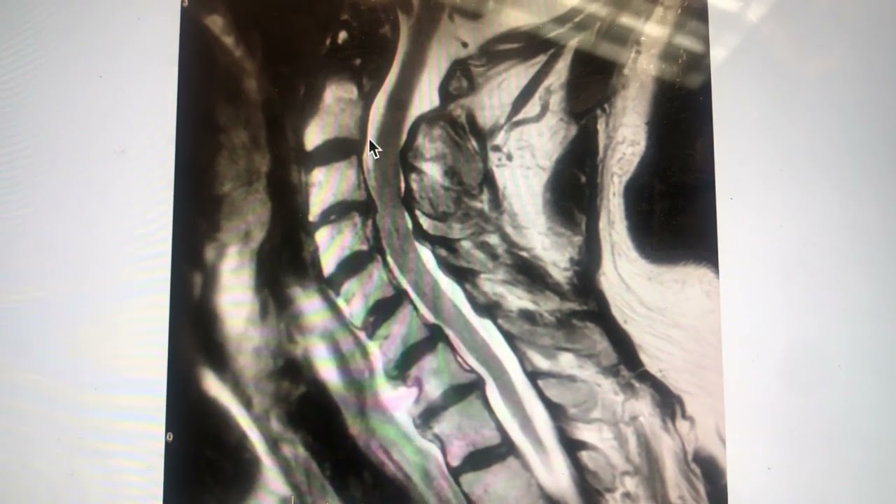 Retrolisthesis at C3-4