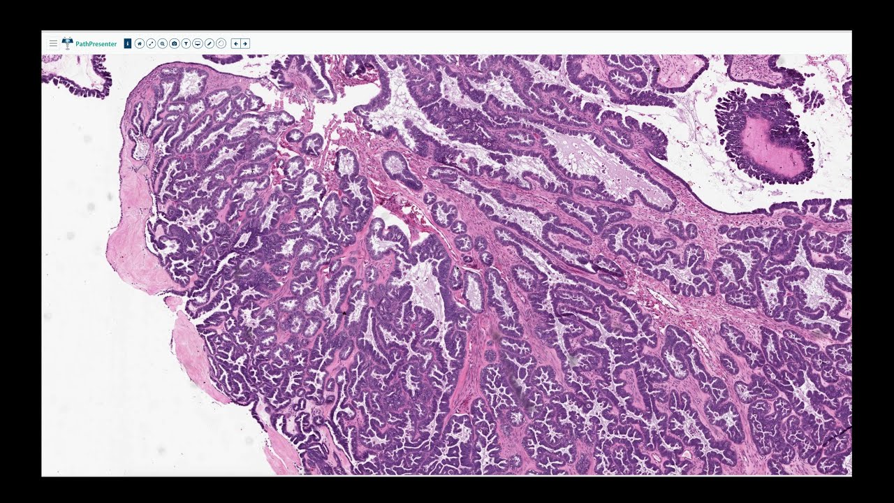 Epithelial Ovarian Tumors Digital Slide Review