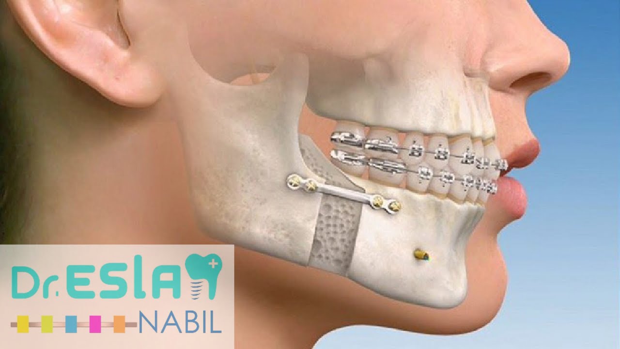 تاثير جراحه الفكين على الوجه #دكتور_اسلام_نبيل