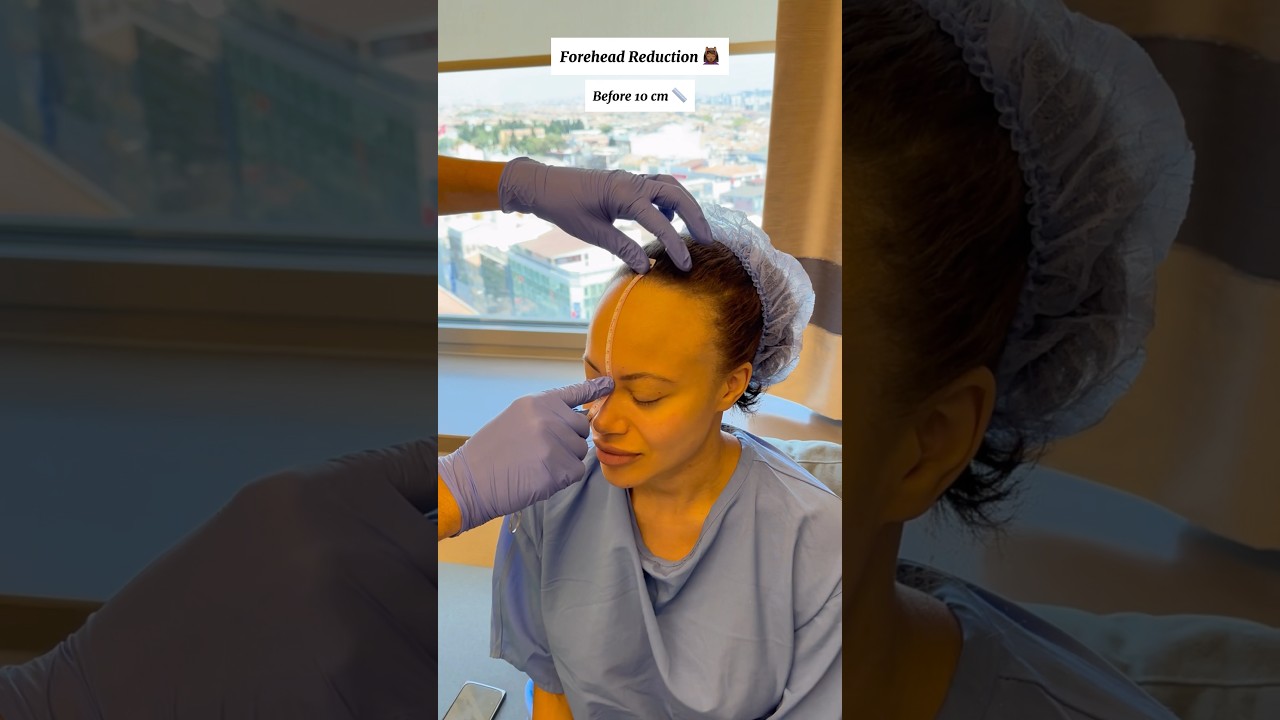 FOREHEAD REDUCTION 💆🏽&zwj;♀️ Dr. Ahmet Dilber #foreheadreduction #hairlinelowering #plasticsurgery