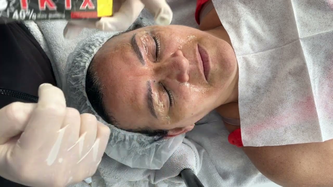 Protocolo exclusivo de jato e plasma na testa