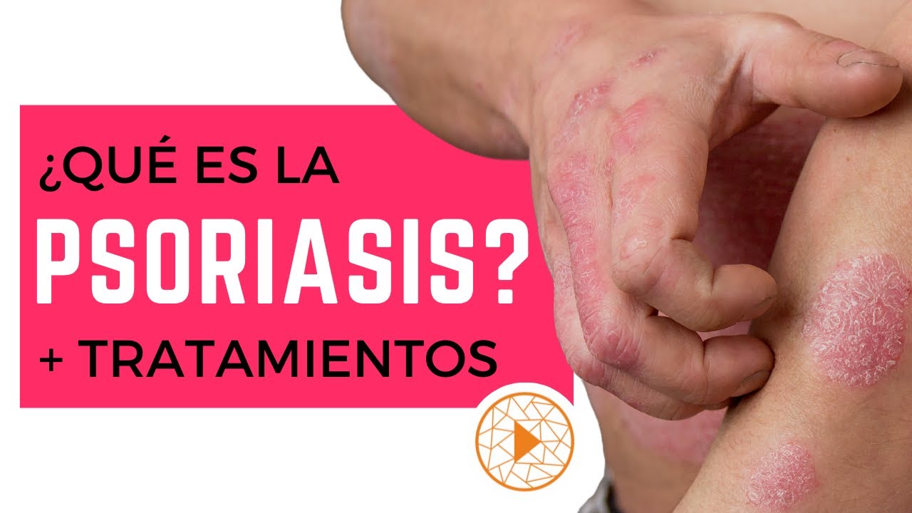 LO QUE NECESITAS SABER SOBRE LA PSORIASIS | Causas, síntomas y tratamientos