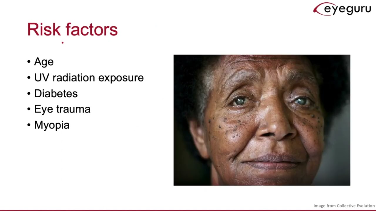 1.3: Cortical Spoking Cataracts