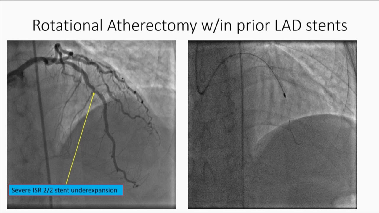 How to Treat Large Vessel Coronary Perforation - Michael Luna, MD