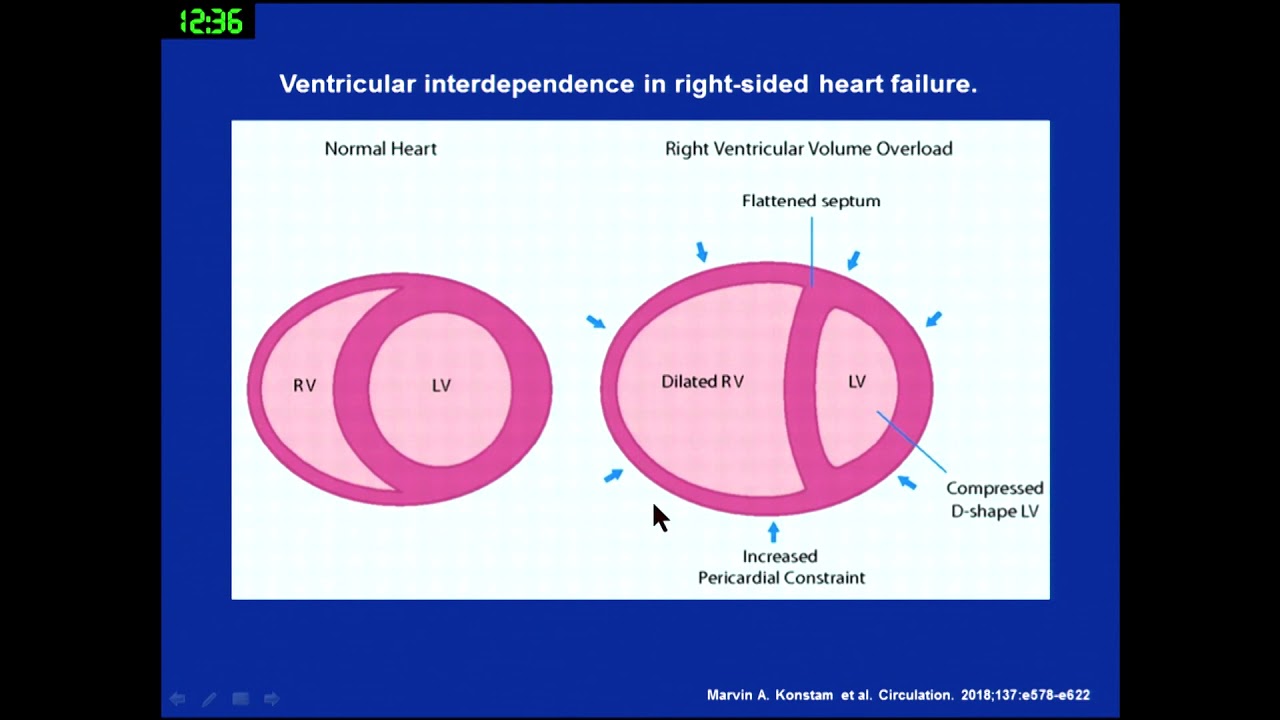 Assessment and management of RV failure before and after LVAD implantation