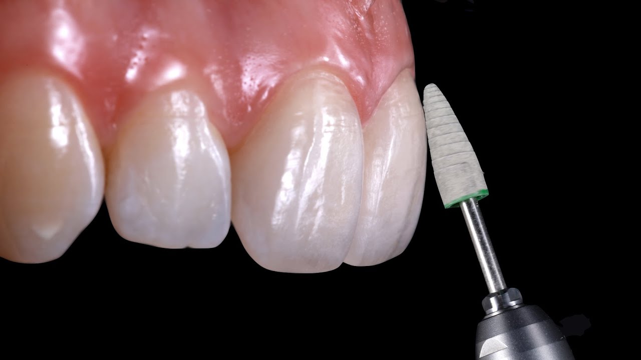 Operative Clinical - Finishing & Polishing