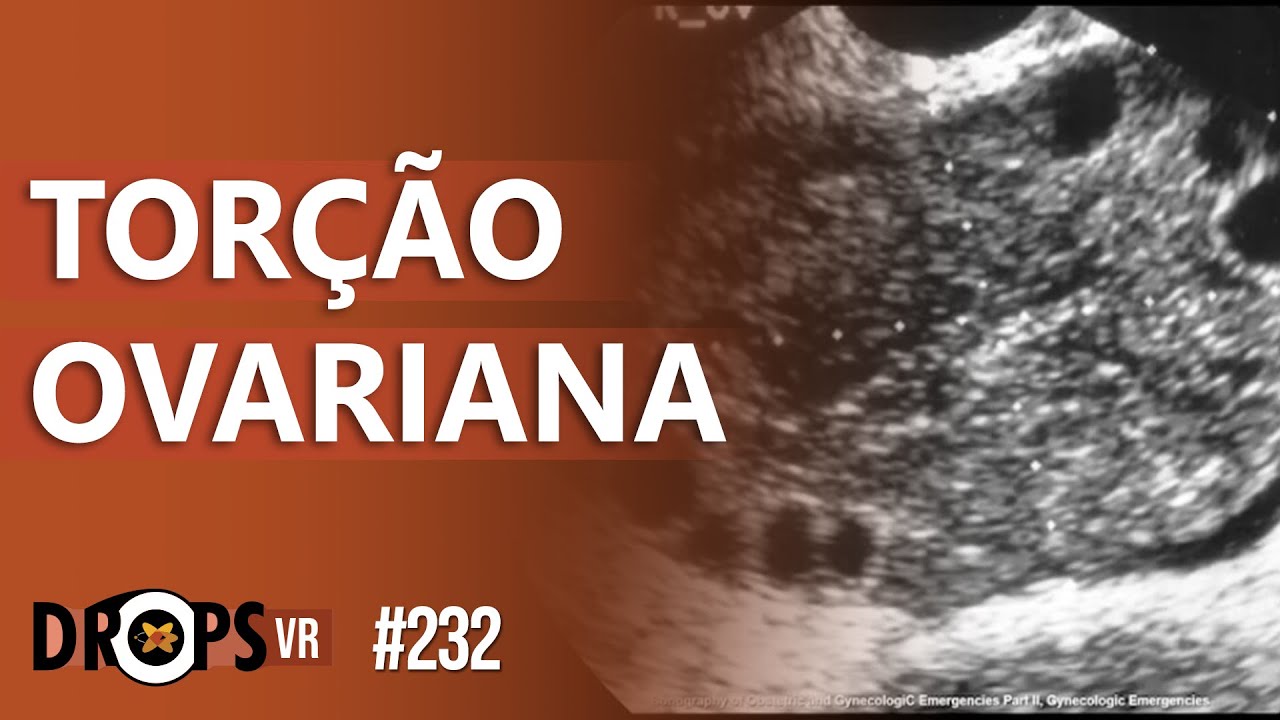 TOR&Ccedil;&Atilde;O OVARIANA - COMO RECONHECER NA IMAGEM