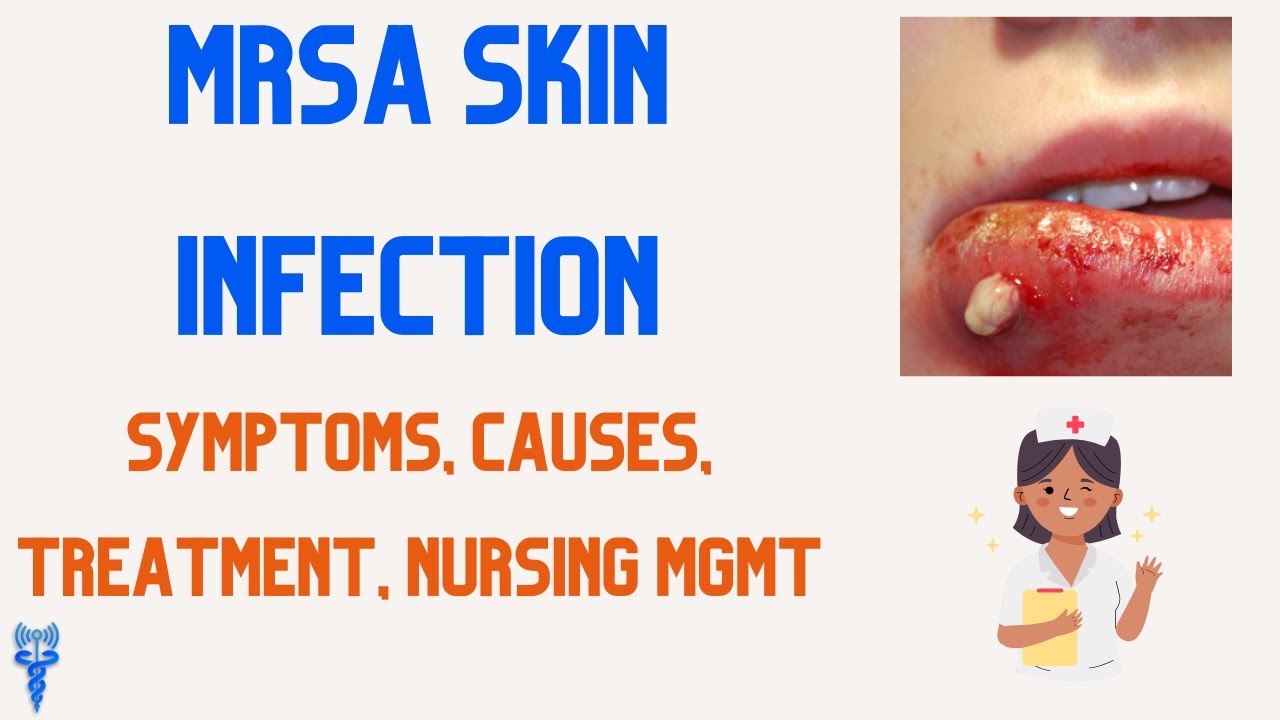 Инфекция кожи, вызванная MRSA: причины, симптомы, лечение и уход