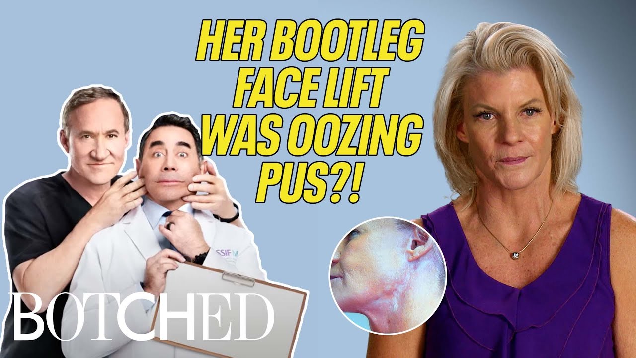 Jo Anna’s Facelift Got INFECTED From Contaminated Poopy Water?| (Before & After) | Botched | E!
