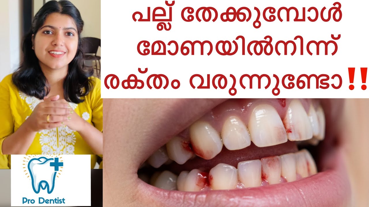 മോണയിൽ നിന്ന് രക്‌തം വരുന്നത് നോർമലാണോ?‼️@Devinevibez-q6n 