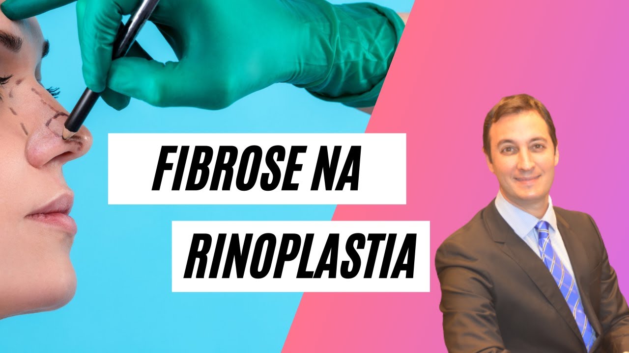 Fibrose na rinoplastia