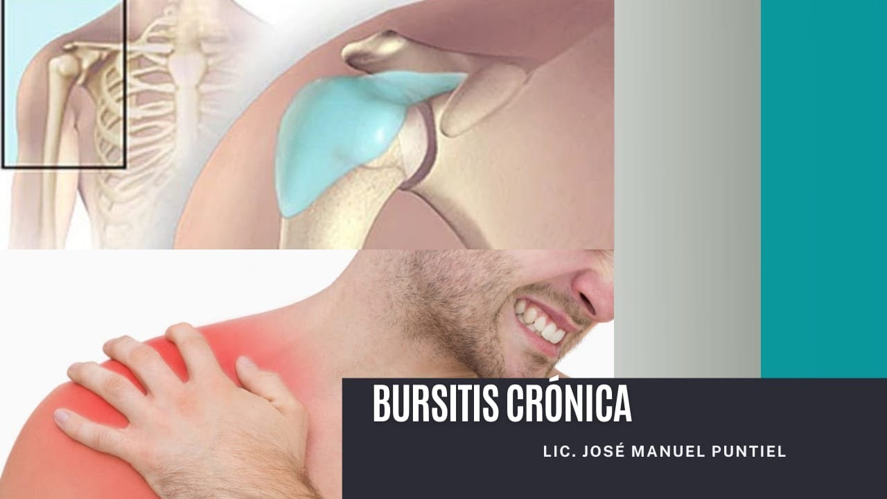 Los mejores ejercicios para la bursitis Crónica del hombro - Fisioterapia RD.
